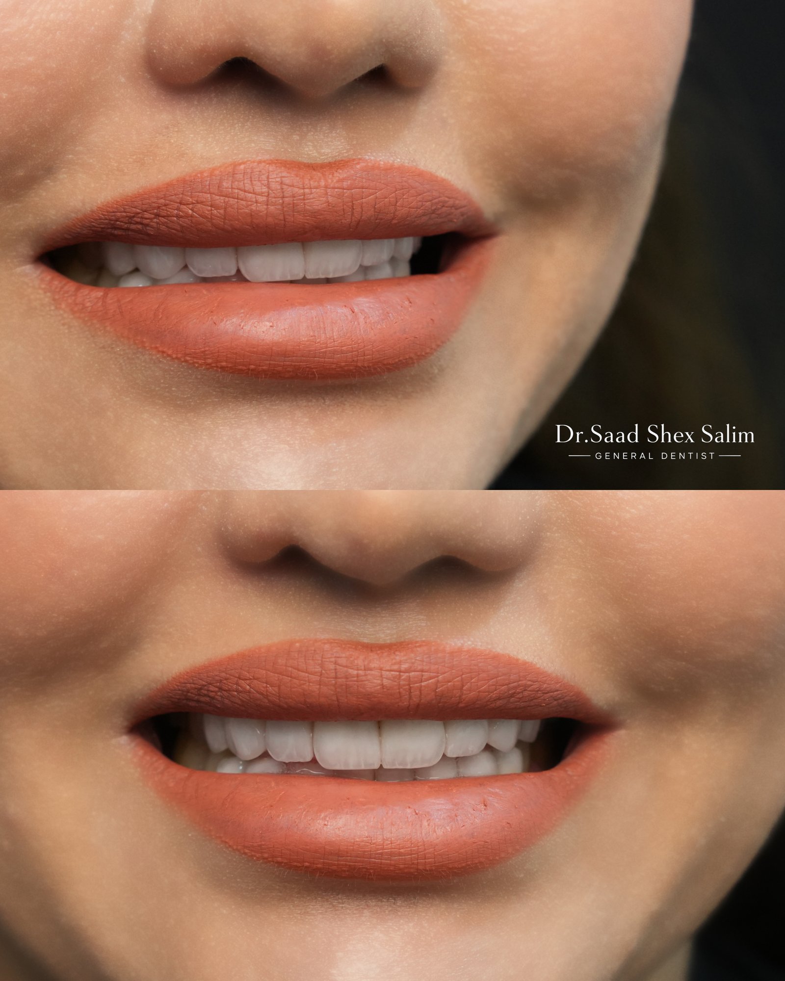 Smile makeover result