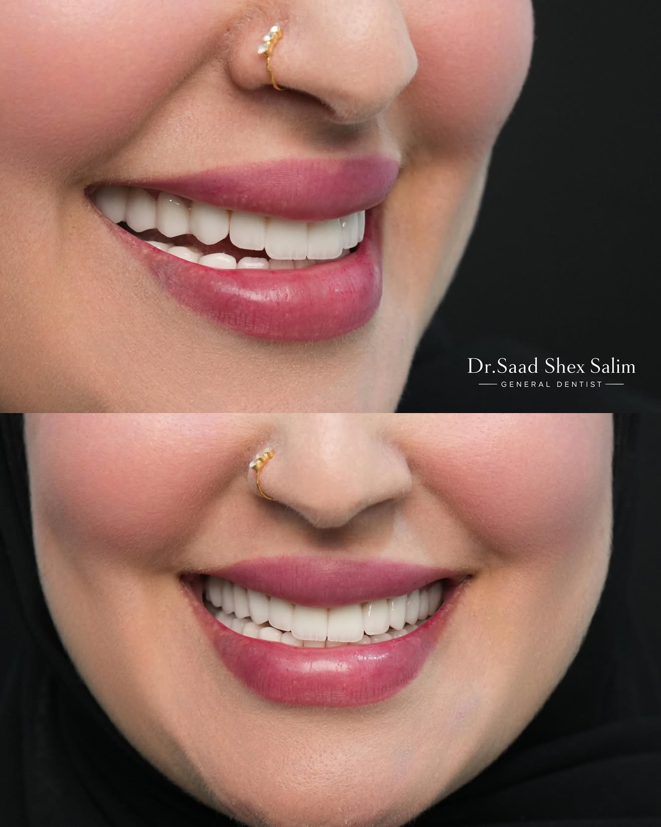 Whitening result