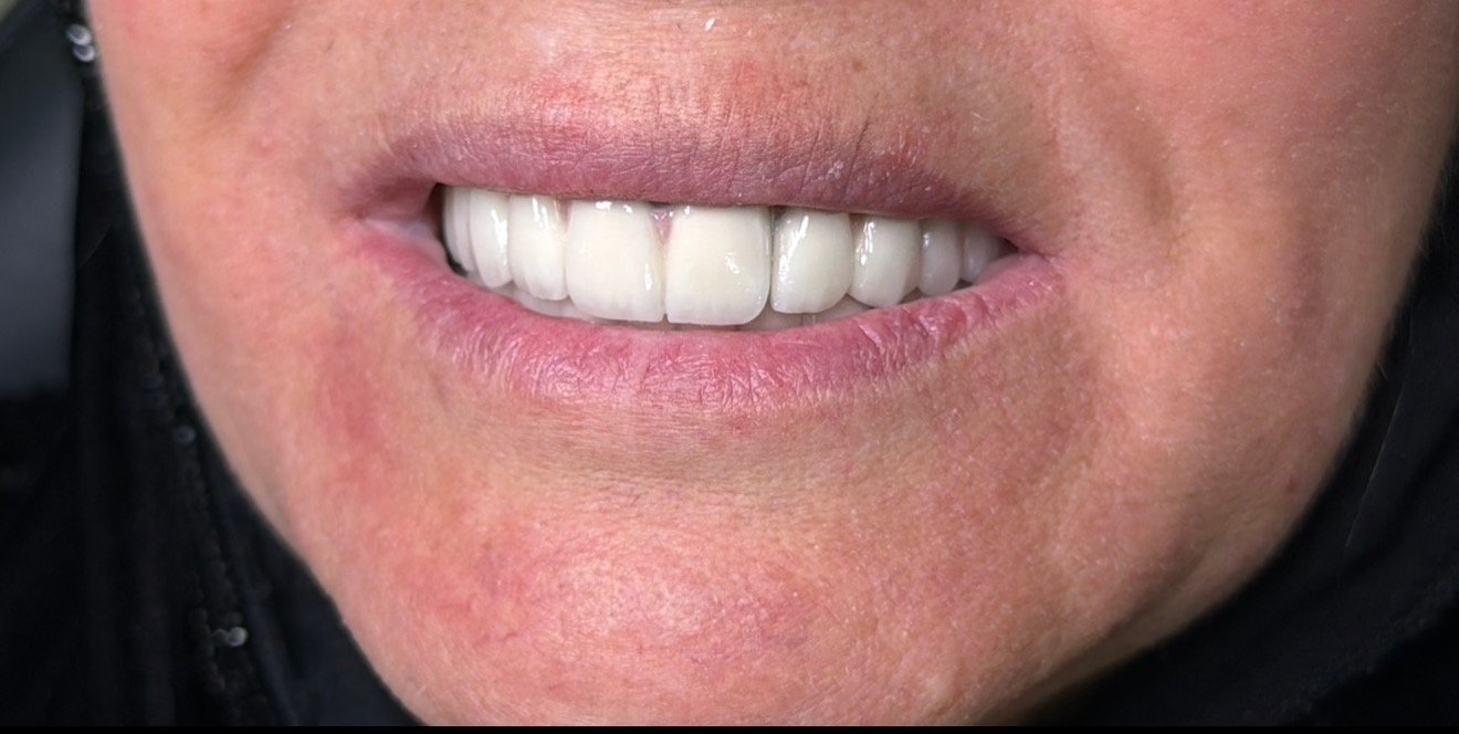 After smile makeover