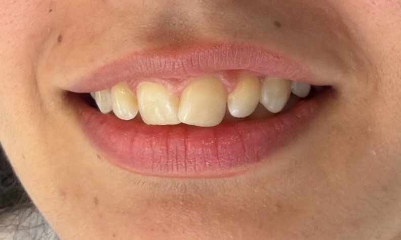 Before smile makeover