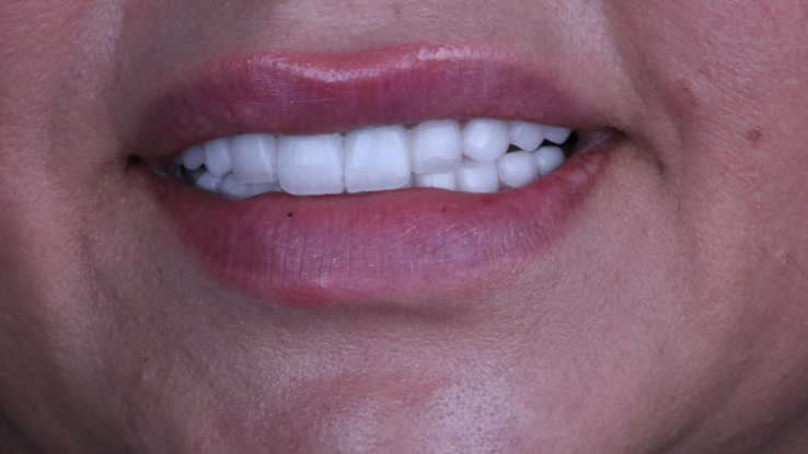 After implants