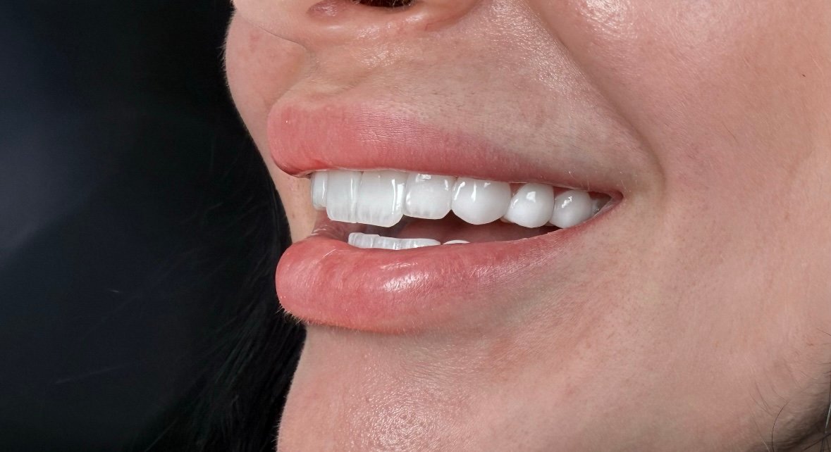 Whitening result